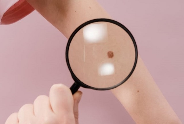 Preventivní vyšetření melanomu