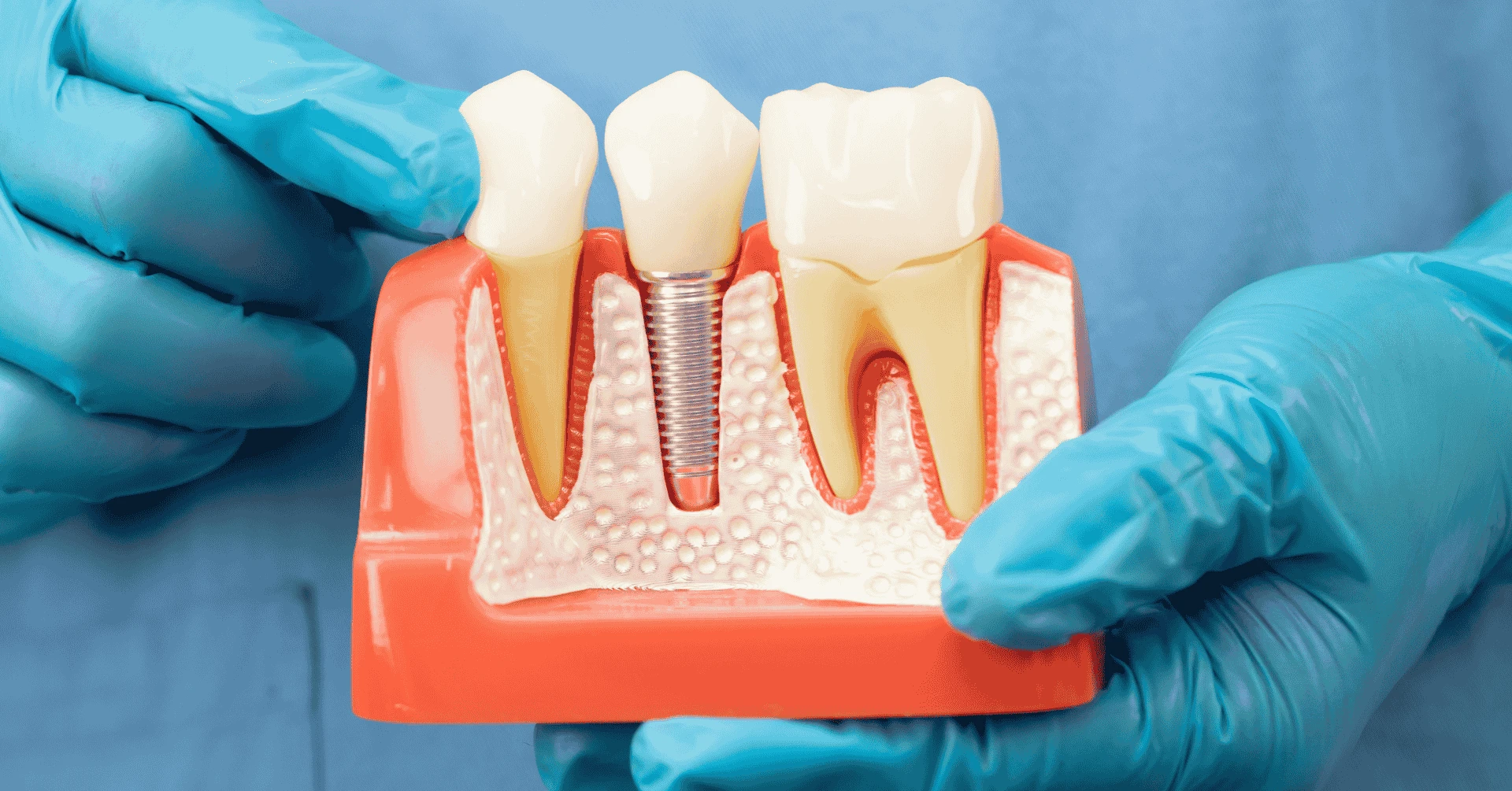 Příspěvek na implantát